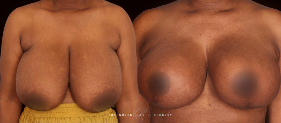 Natasha Nzara Breast Reduction and Lift front