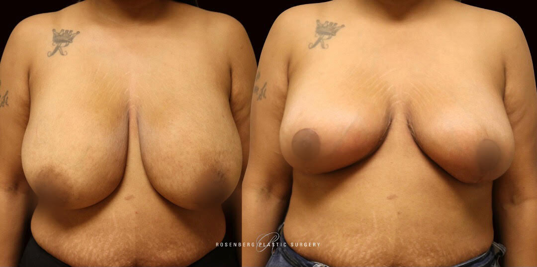 Breast Reduction and Lift Results