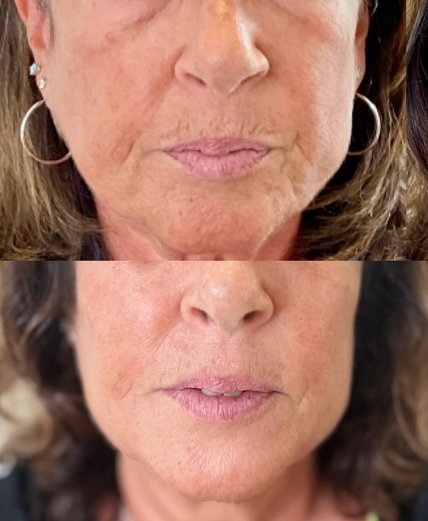 Mid-face-and-lower-face-Radiesse 