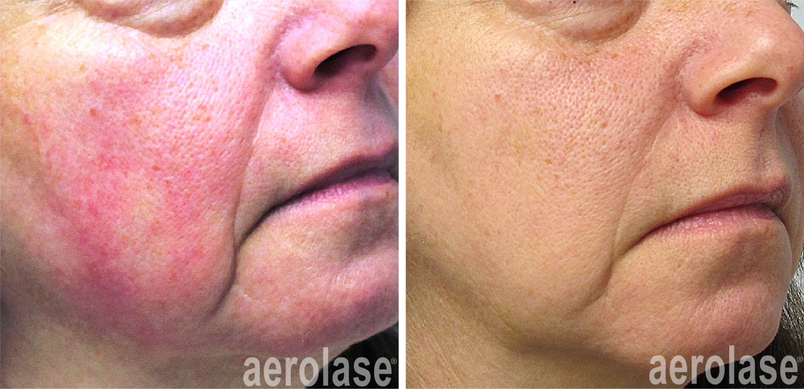 aerolase-rosacea-yelena-kipervas-1-treatment