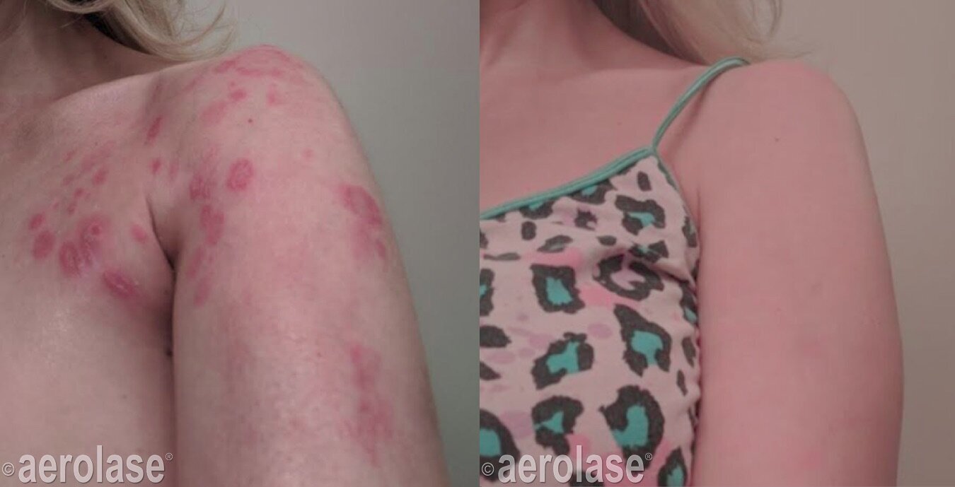 Psoriasis - Shoulder After 4 tx copy