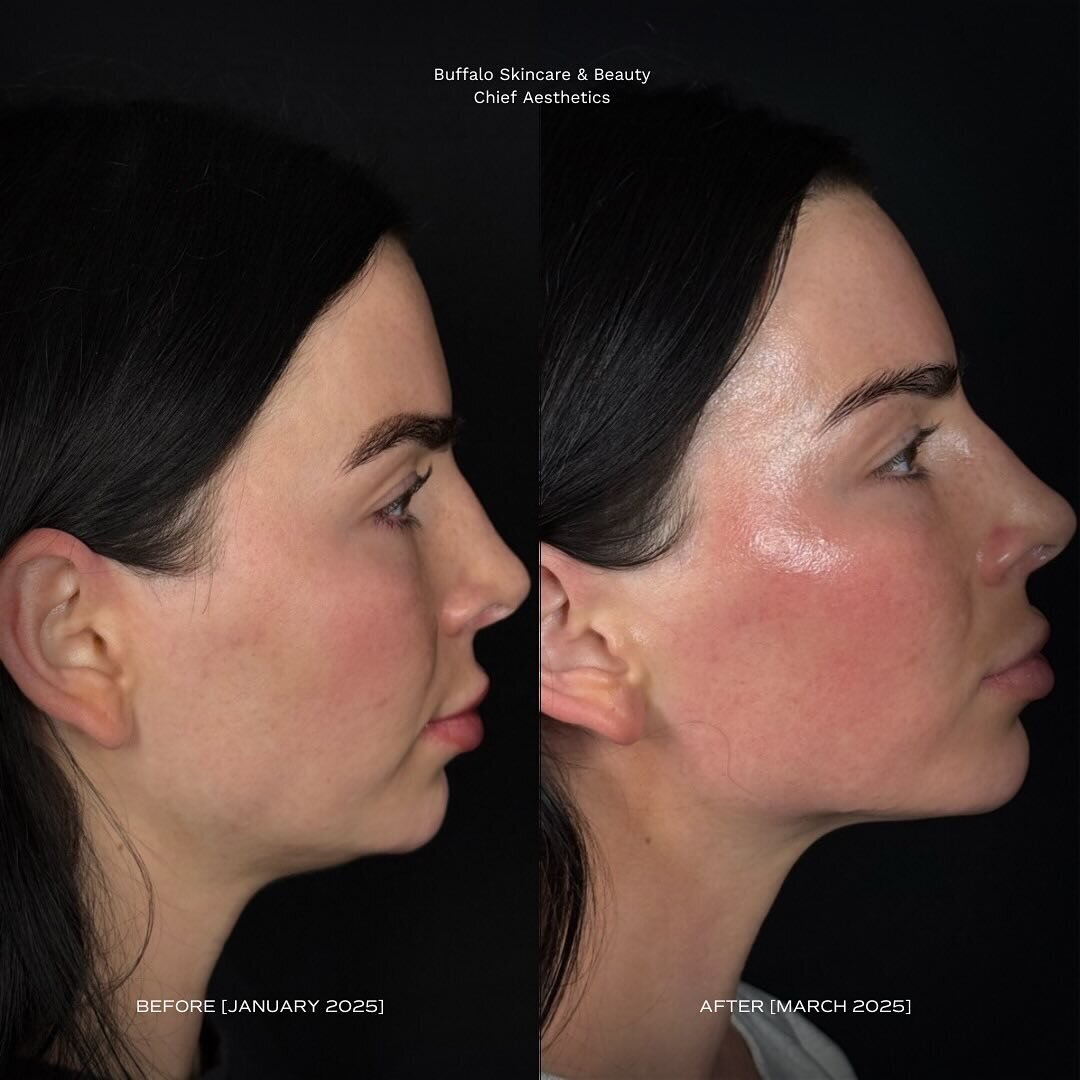 ultherapy-before-after-skin-tightening-aesthetic-treatment-williamsville-new-york