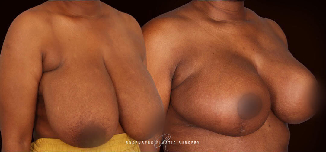 Breast Reduction and Lift Results