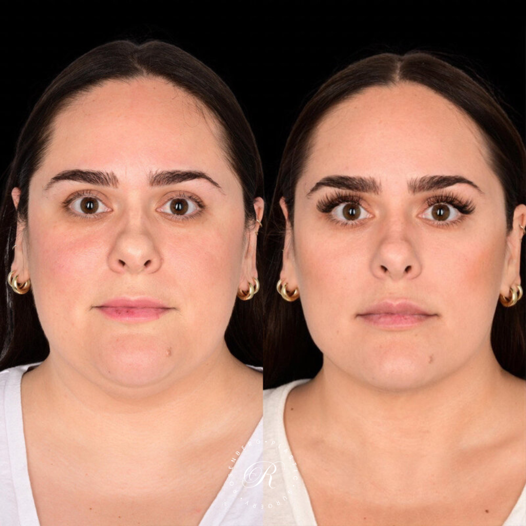 Neck Lipo RPS Before & After.zip - 9