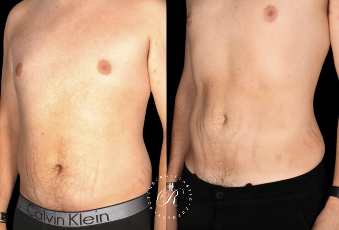 Liposuction of Abs, Back and Flanks RPS Before & After.zip - 10