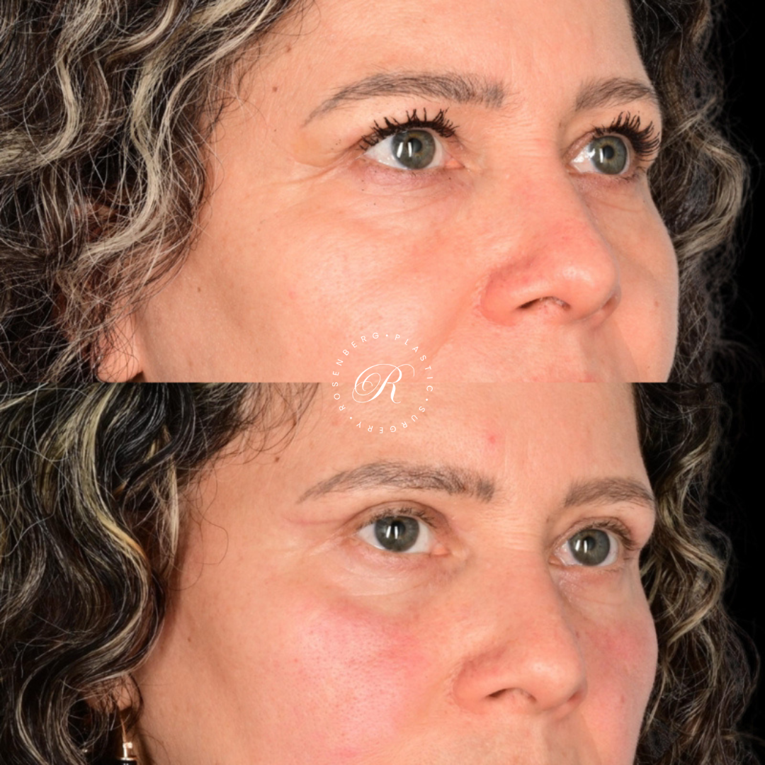 Blepharoplasty RPS Before & After.zip - 4