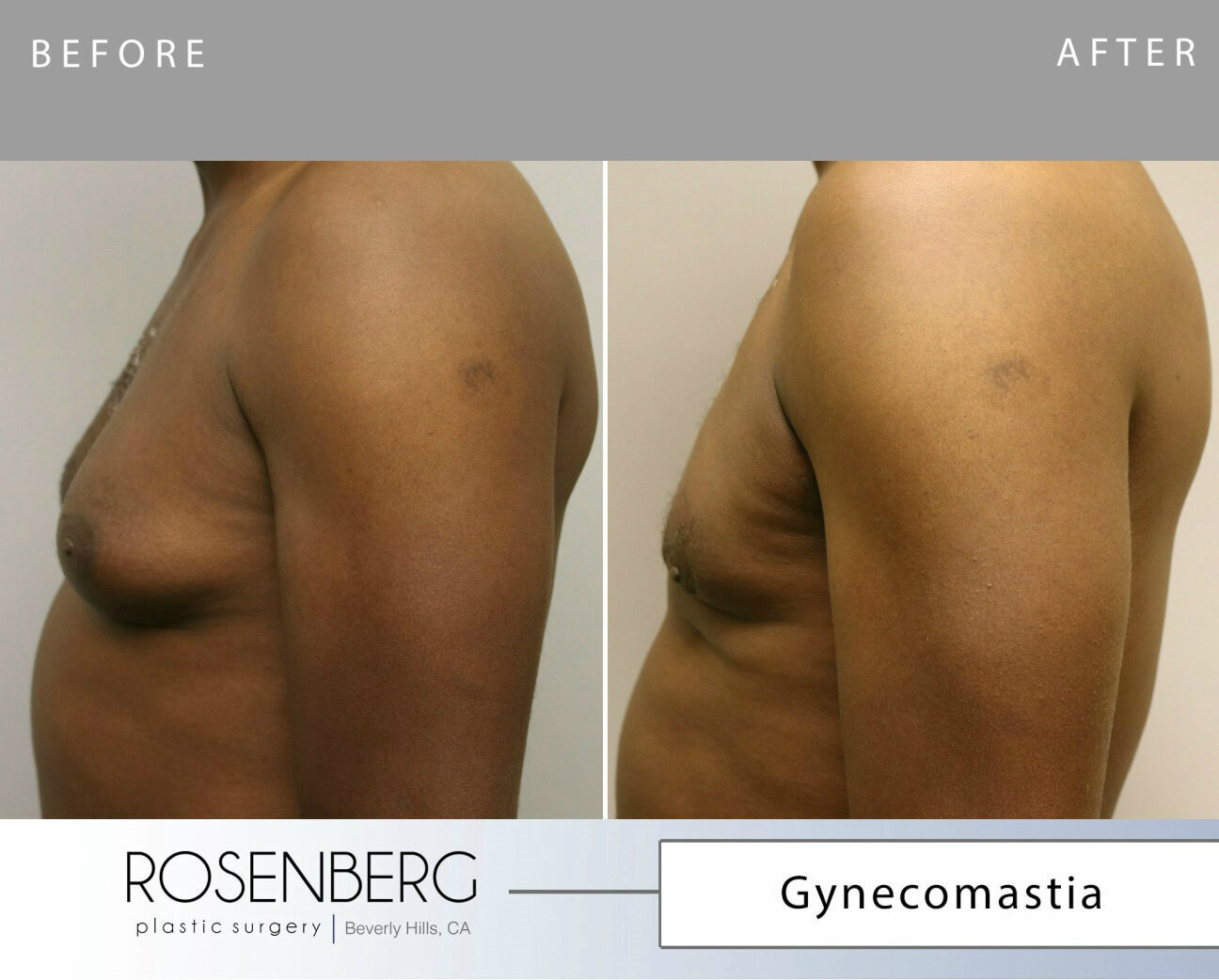 Gynecomastia Results