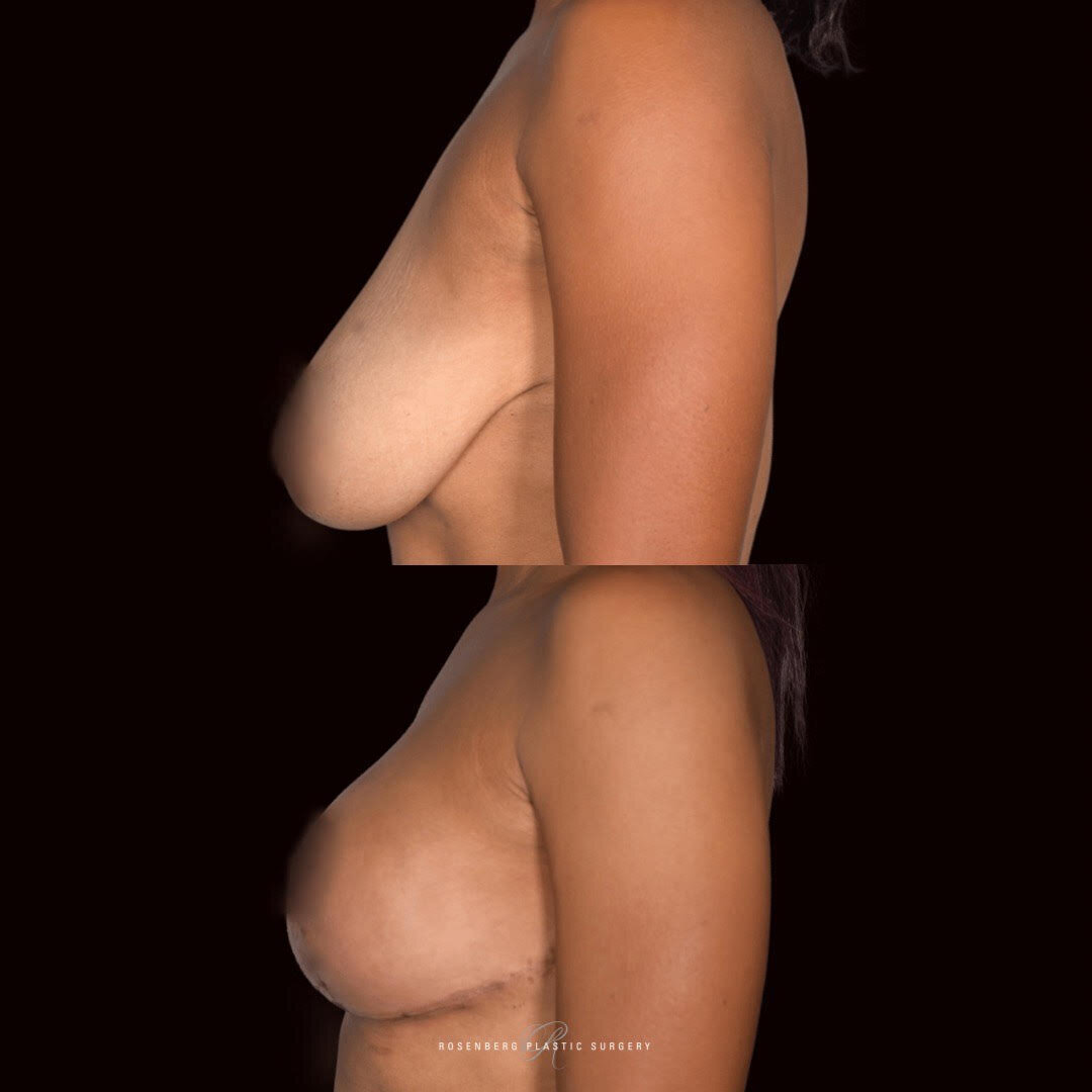 Breast Lift Results