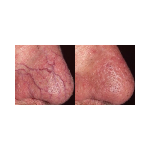 Before and after vascular lesion treatment using DermaLight KTP laser