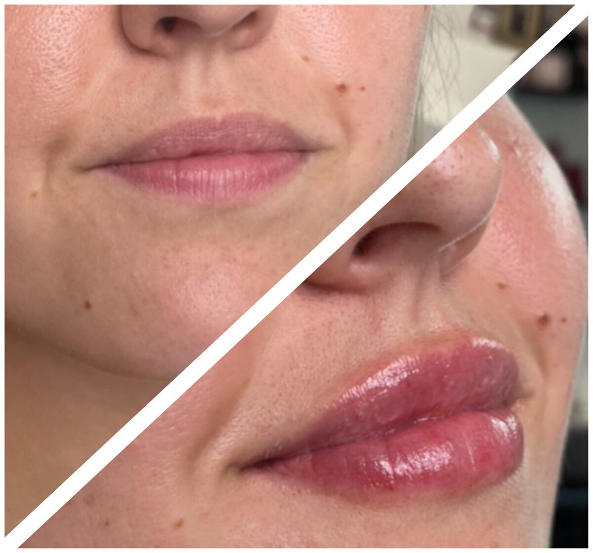 W Aesthetics Dermal Fillers Before and After. Austin Texas 7