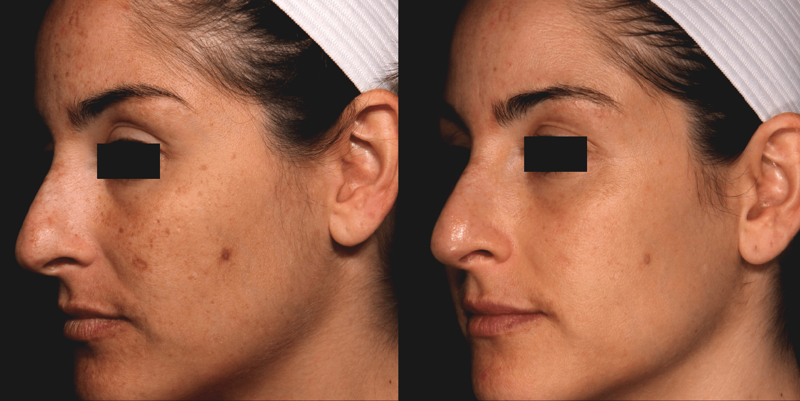 Picosure Hyperpigmentation