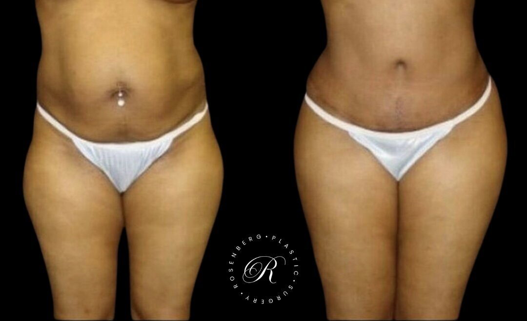 Fat Transfer to Hips + BBL RPS Before & After.png