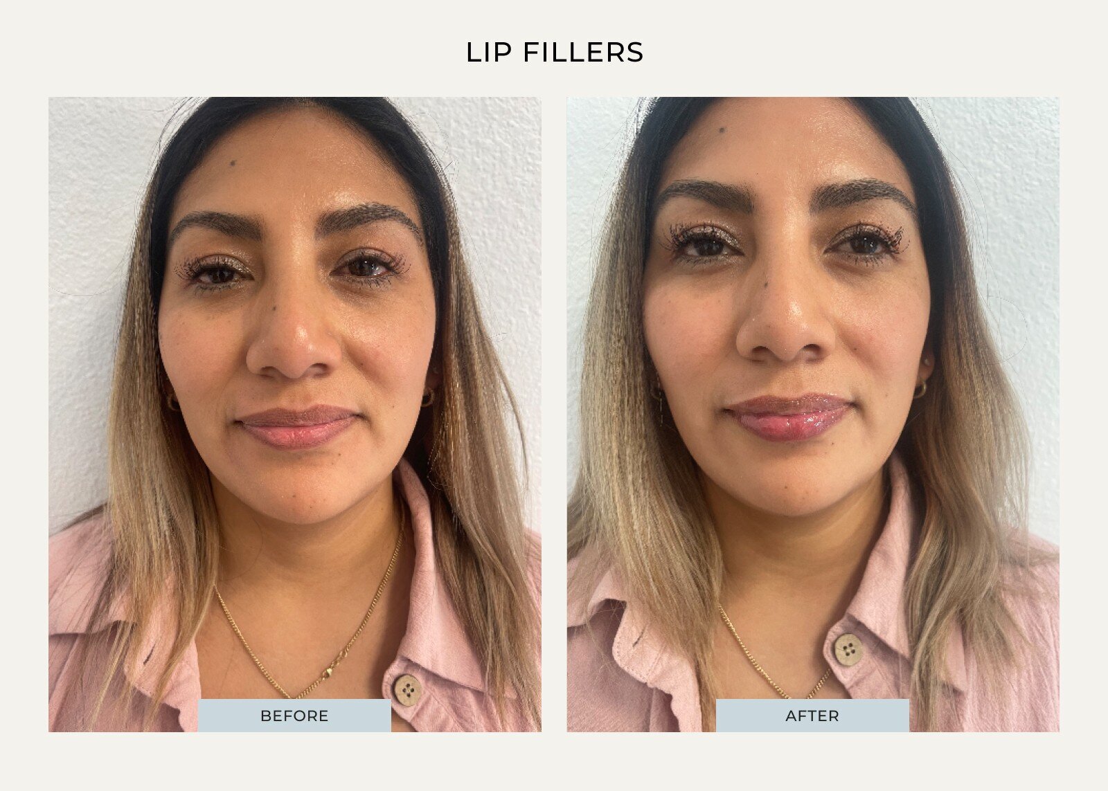 beauty-by-kd-client9-lip-fillers