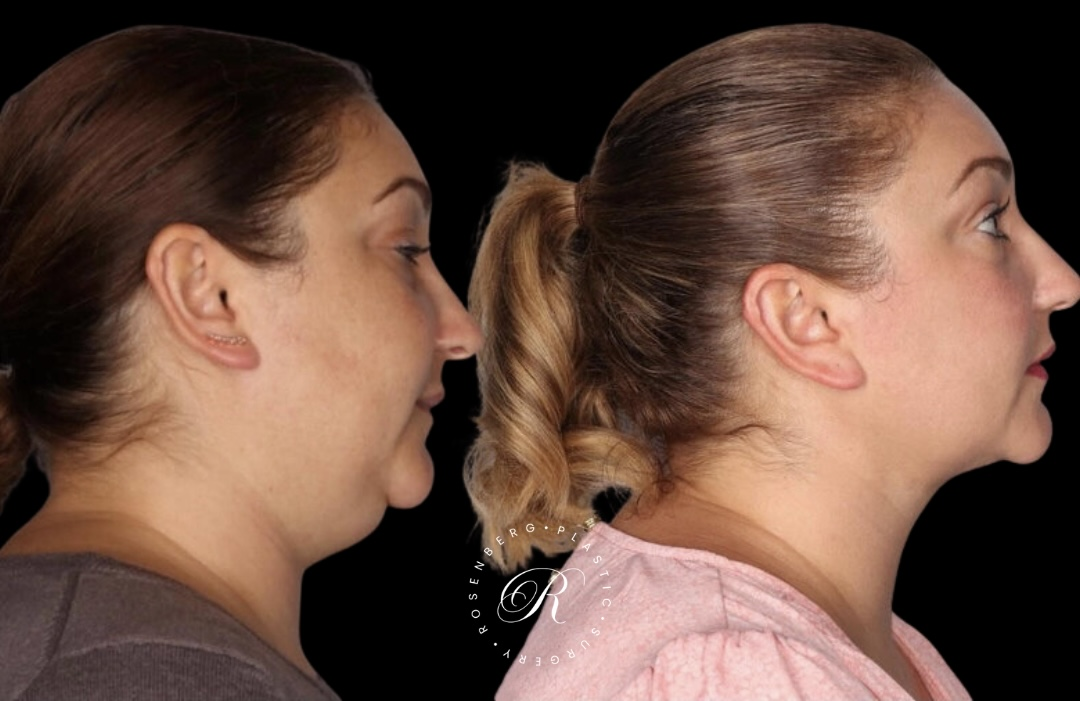 Neck Lipo RPS Before & After.zip - 24