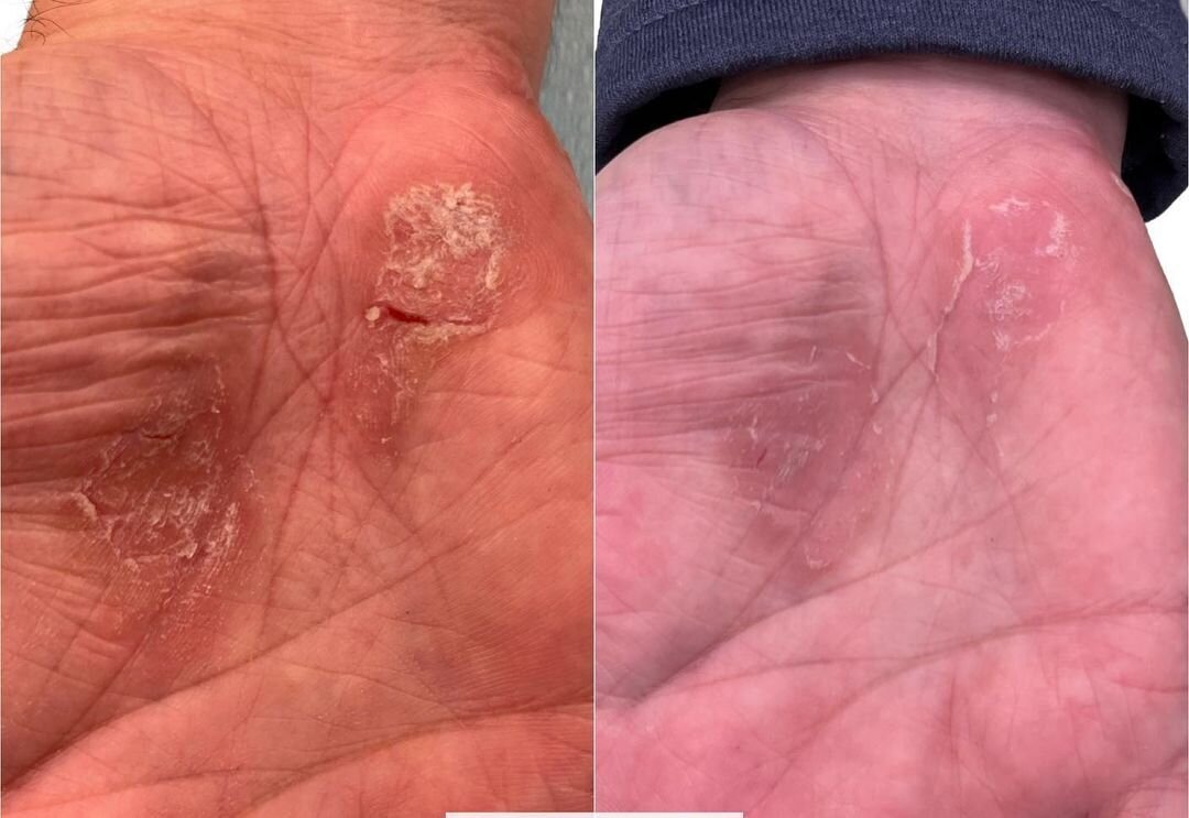 Psoriasis by Aerolase