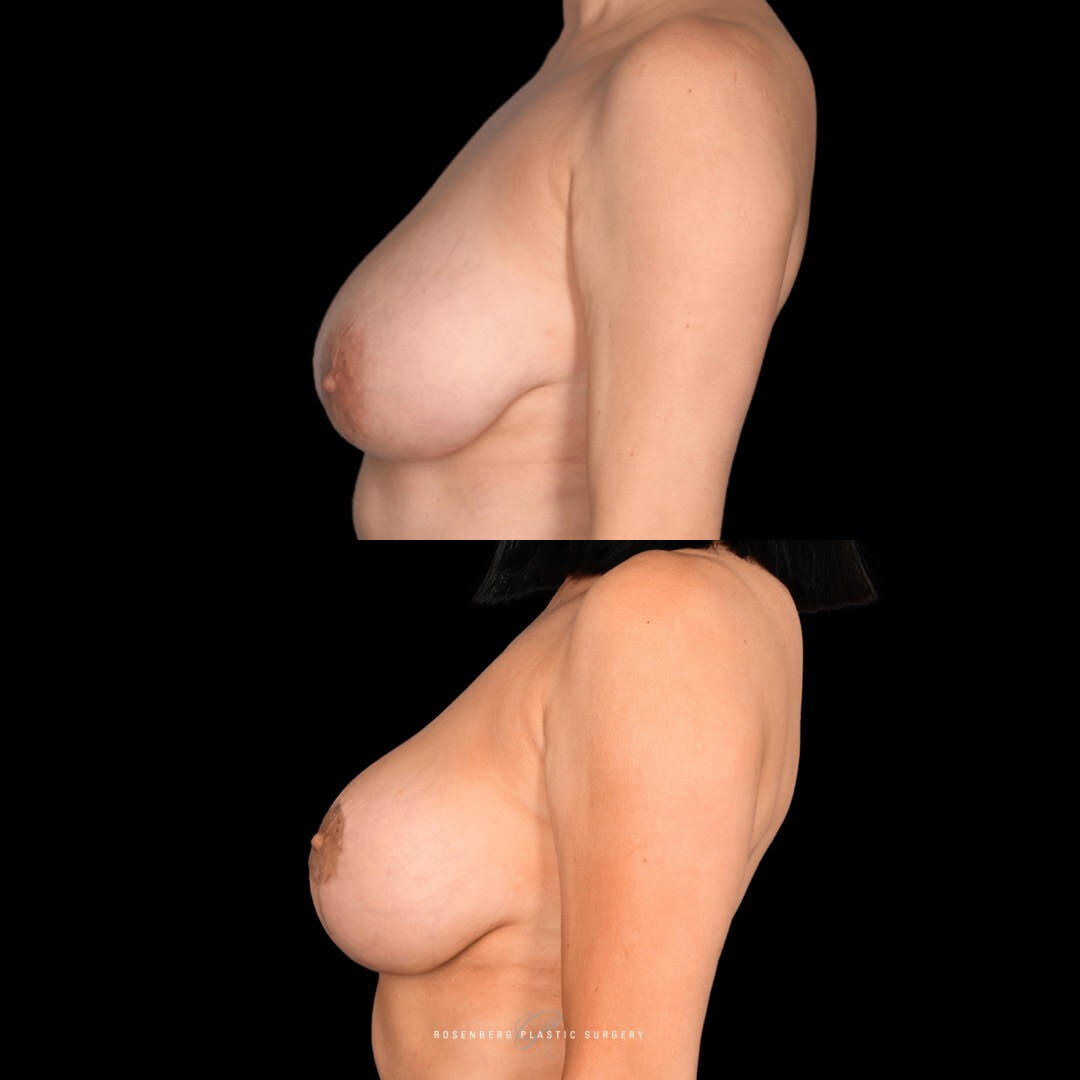 Breast Reduction and Lift Results