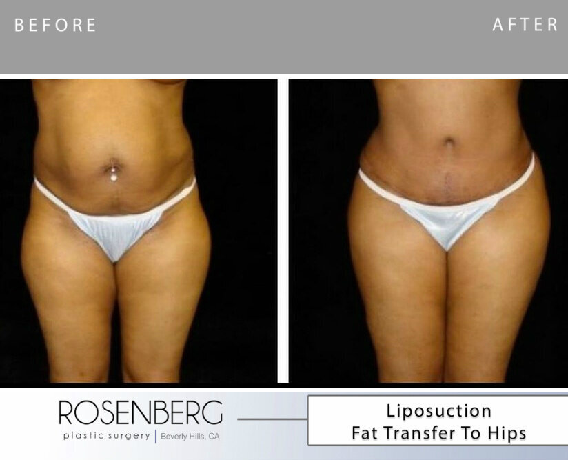 Lipo Fat Ransfer to hips