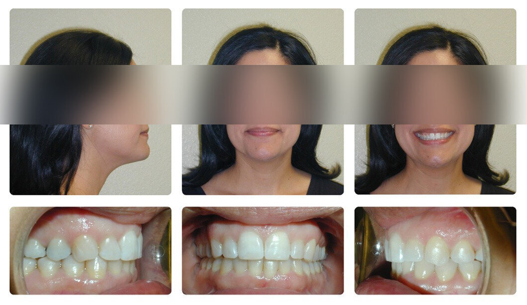 cristiana-alicino _invisalign-7