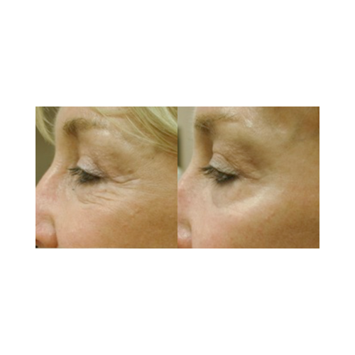 Wrinkle and fine line reduction after fractional CO₂ laser resurfacing