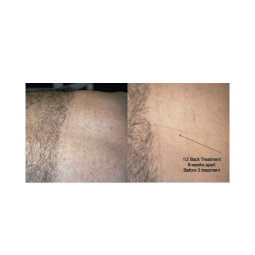 Full body permanent hair reduction with Cervello diode laser