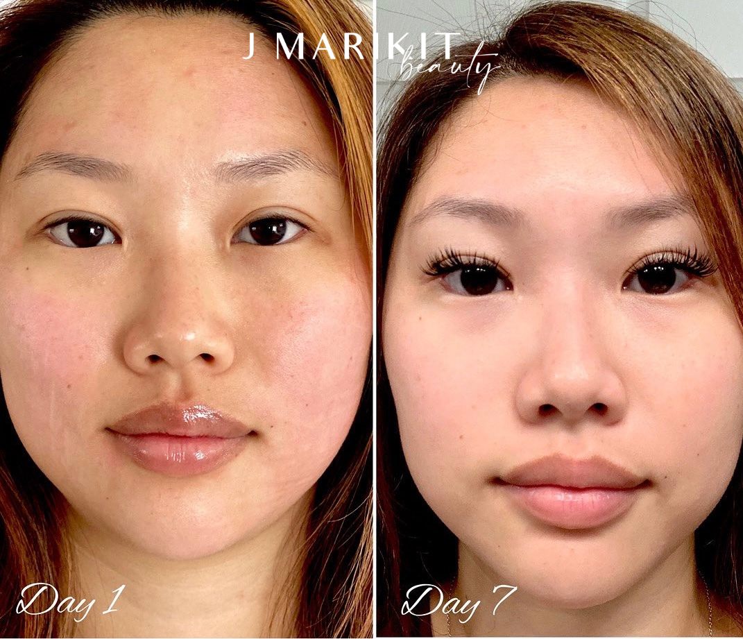 Skin treatment before and after images. Exfoliation Oahu.