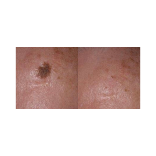 Pigmentation correction results with KTP laser technology