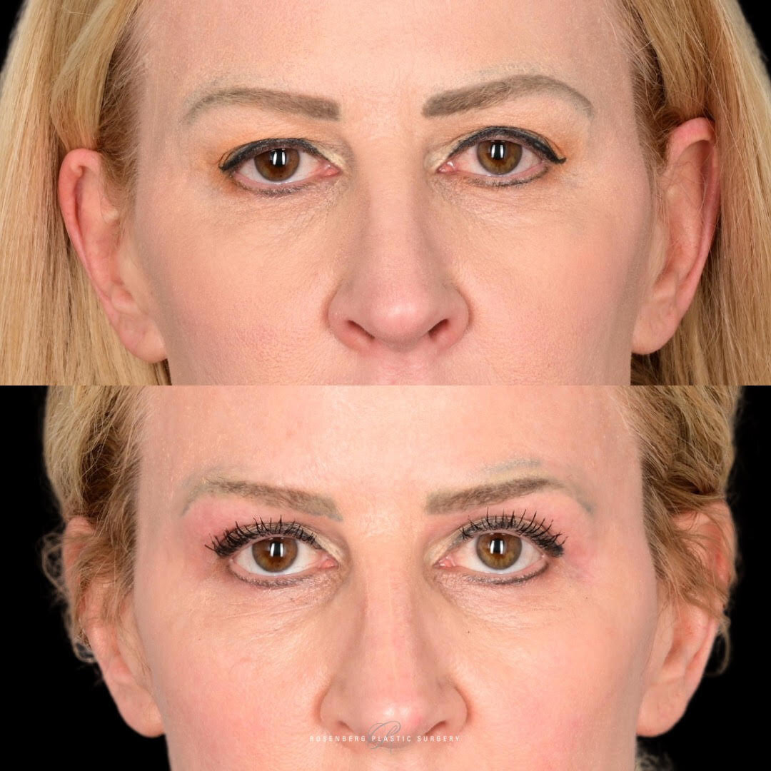 Blepharoplasty Results