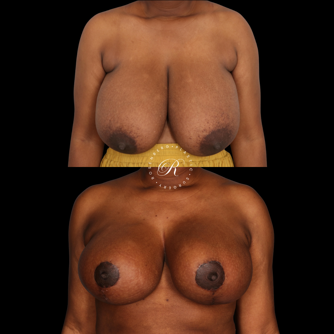 Breast Lift & Reduction RPS Before & Afters.zip - 4
