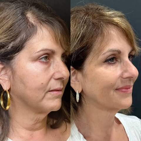 Ultherapy-chief-aesthetic-ny-2