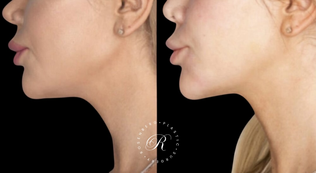 Neck Lipo RPS Before & After.zip - 6