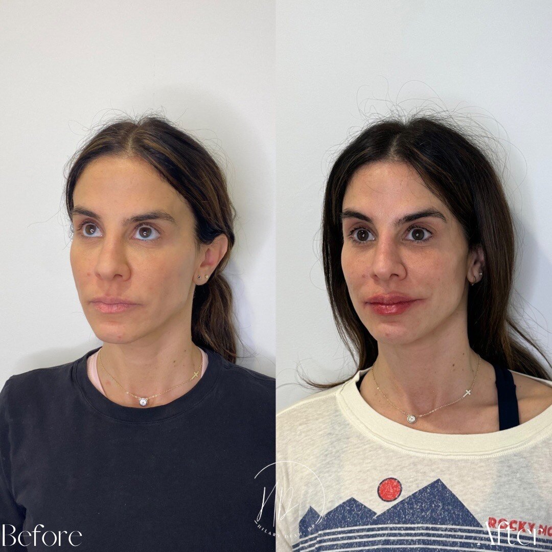 canova-aesthetics-med-spa-before-after-injectables-6