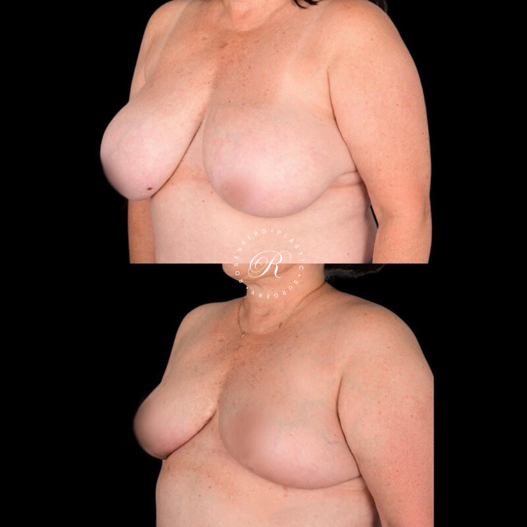 Breast Lift & Reduction RPS Before & Afters.zip - 52