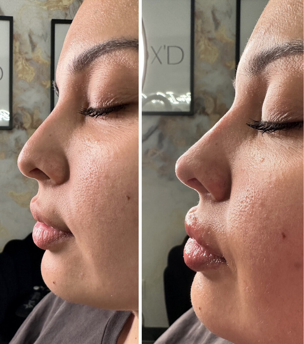 W Aesthetics Non Surgical Rinoplasty  Before and After Austin Texas4
