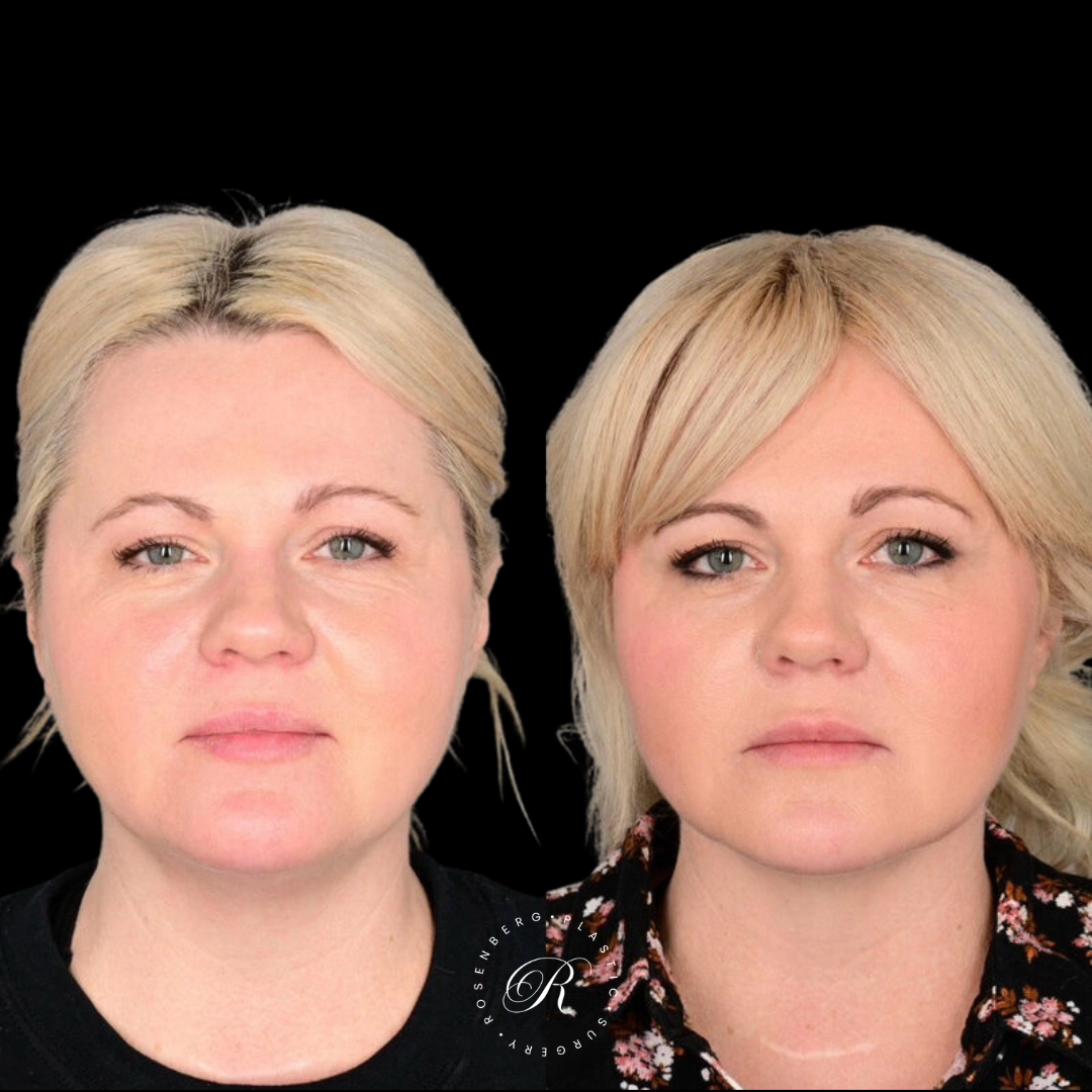 Neck Lipo RPS Before & After.zip - 19