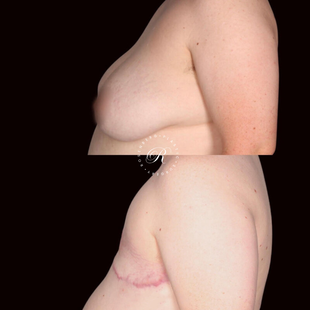Top Surgery RPS Before & After.zip - 4
