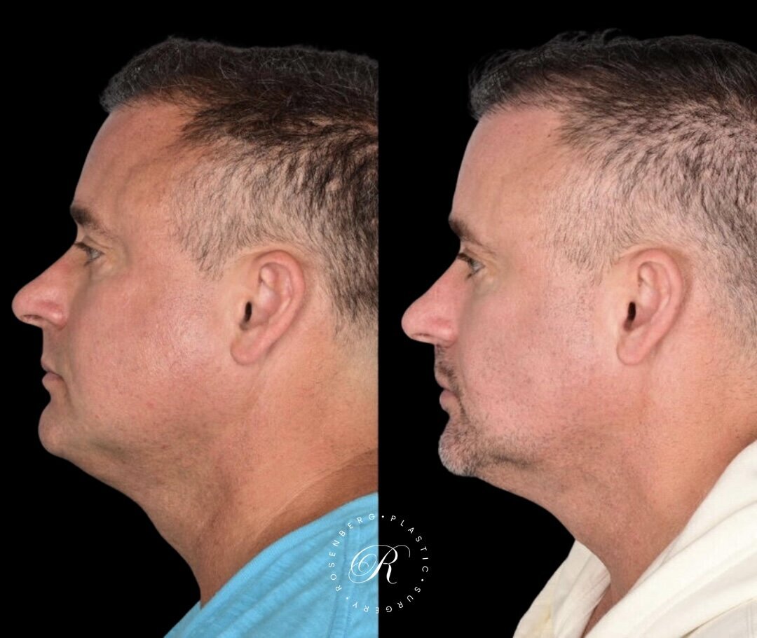 Buccal Fat Pad Removal RPS Before & After.zip - 2