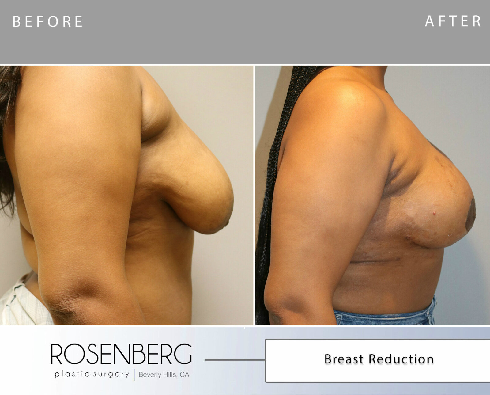 Germaine Breast Reduction Before 