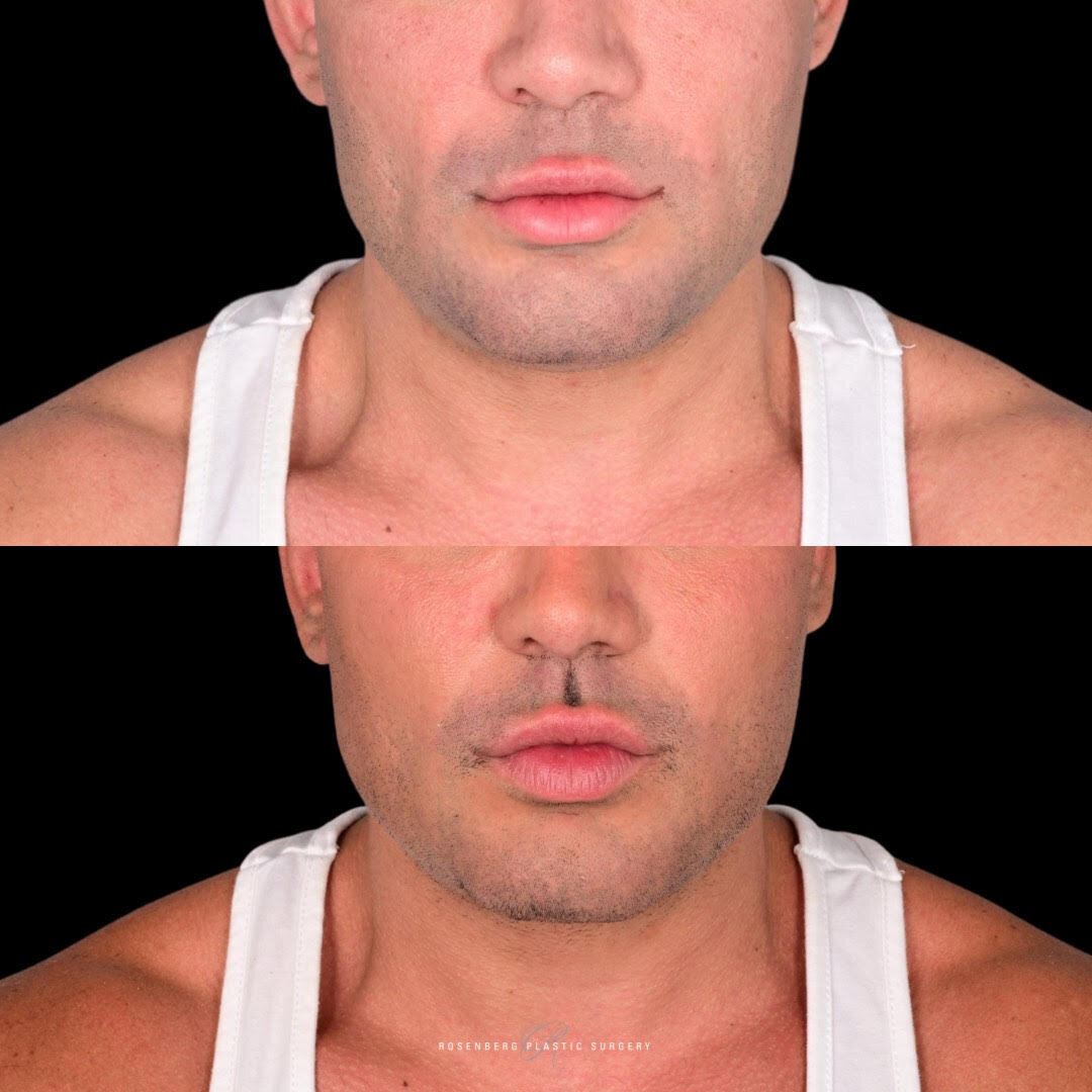 Neck Liposuction Results