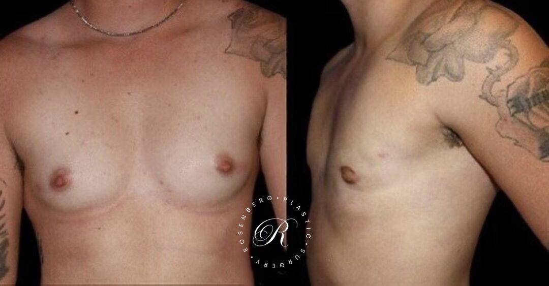 Top Surgery RPS Before & After.zip - 10