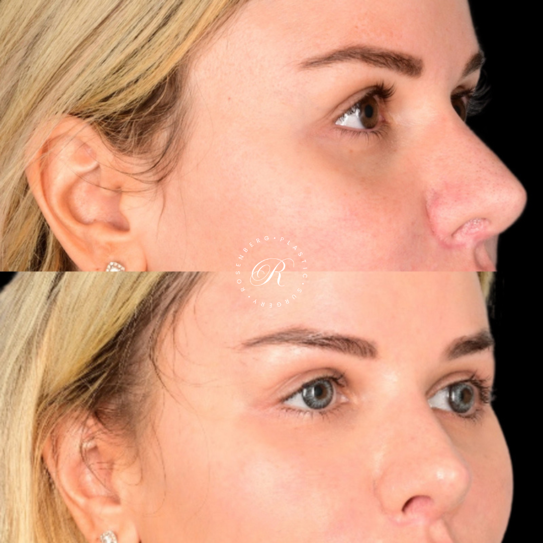 Blepharoplasty RPS Before & After.zip - 5