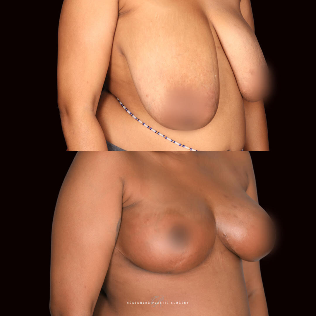 Breast Reduction and Lift Results