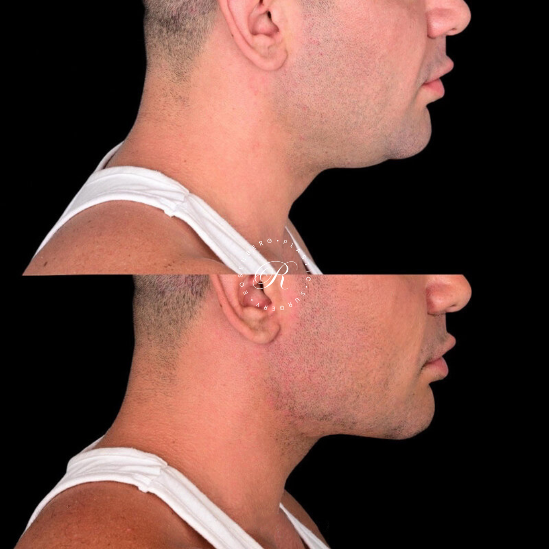 Neck Lipo RPS Before & After.zip - 30