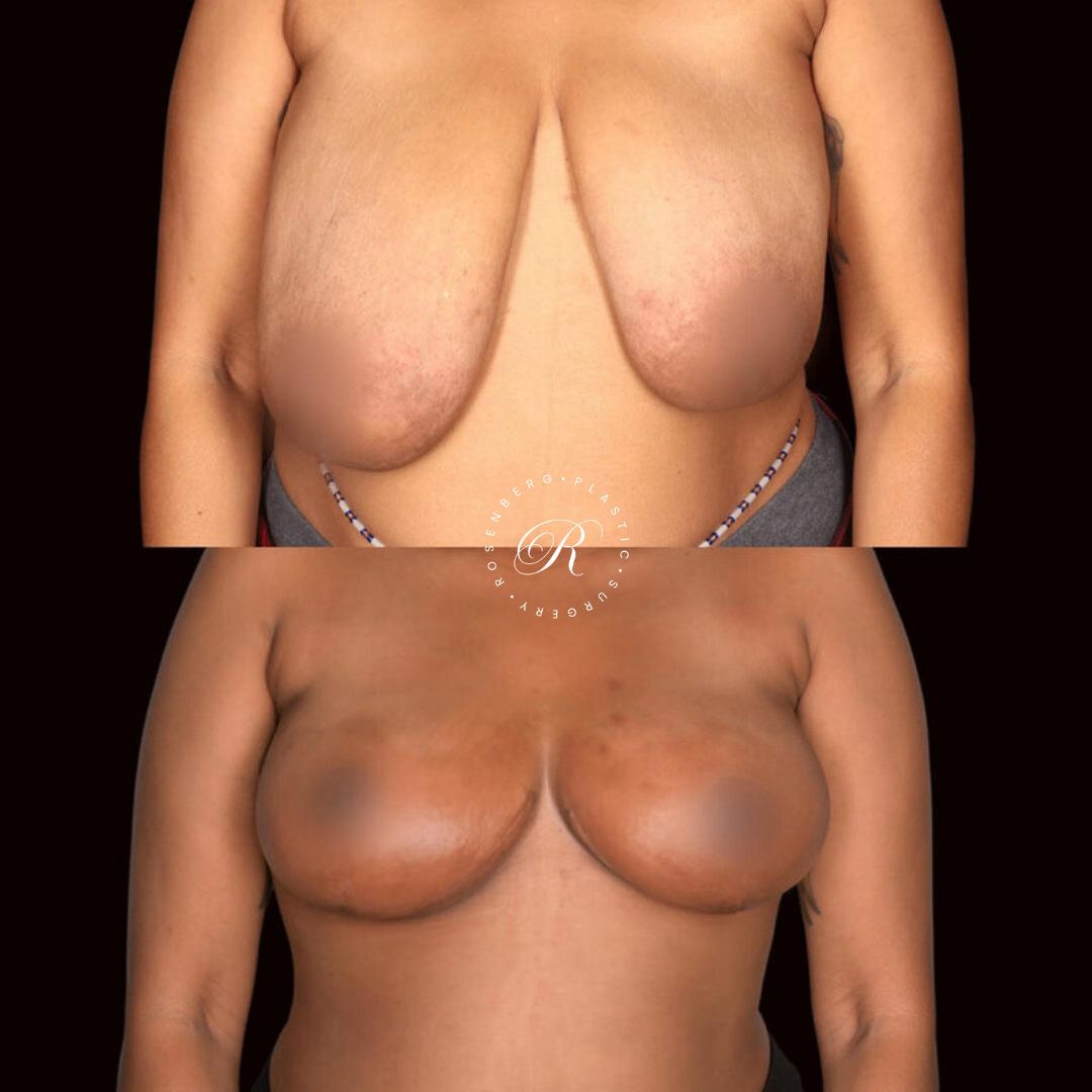 Breast Lift & Reduction RPS Before & Afters.zip - 25