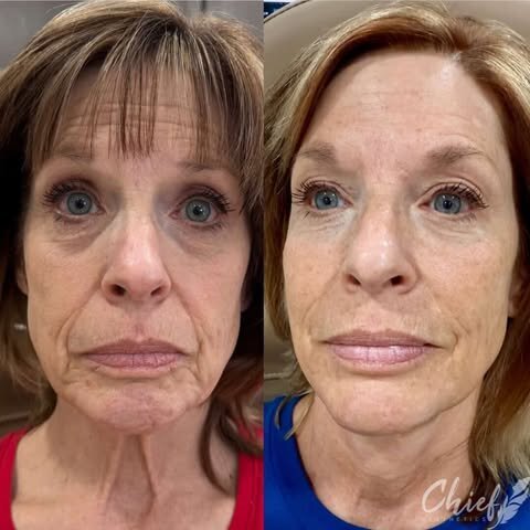 new-york-neck-rejuvination-tighten-muscles-anti-aging-aesthetic-treatment-before-and-after-by-chief-aesthetics-1