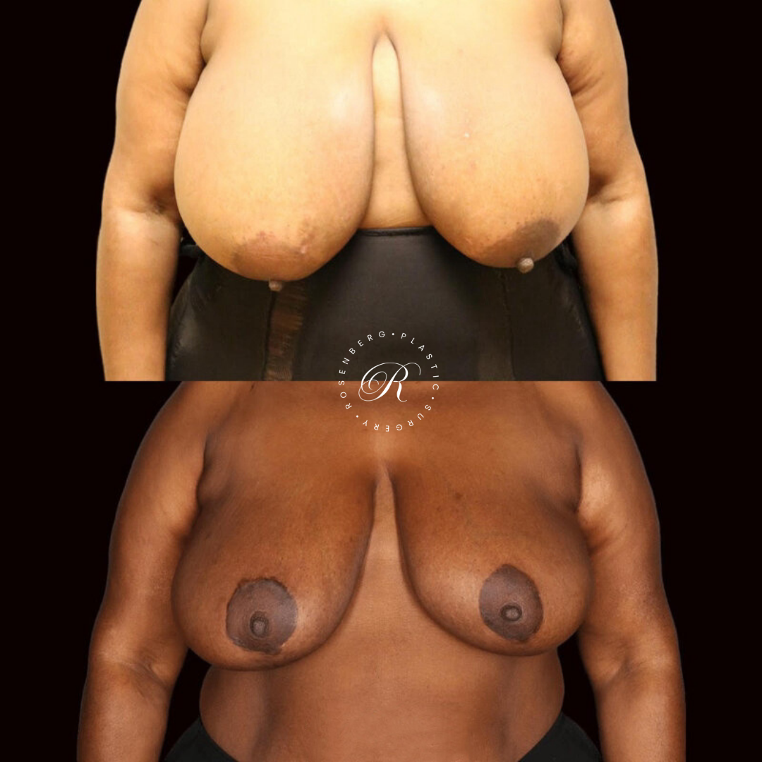 Breast Lift & Reduction RPS Before & Afters.zip - 10