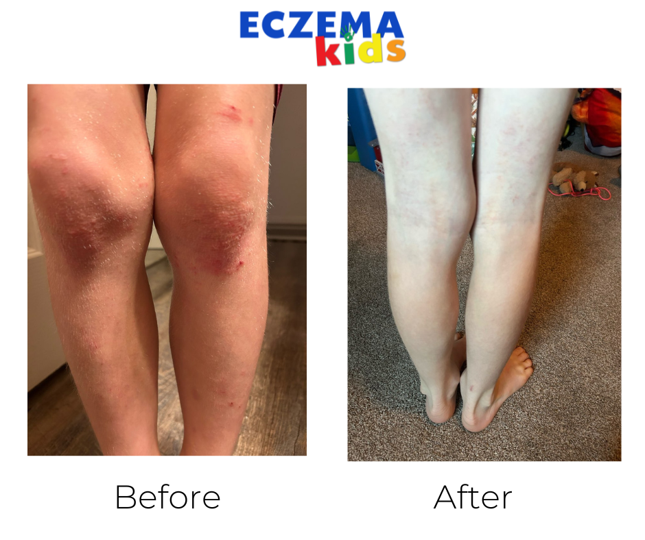 natural eczema healing Coulter
