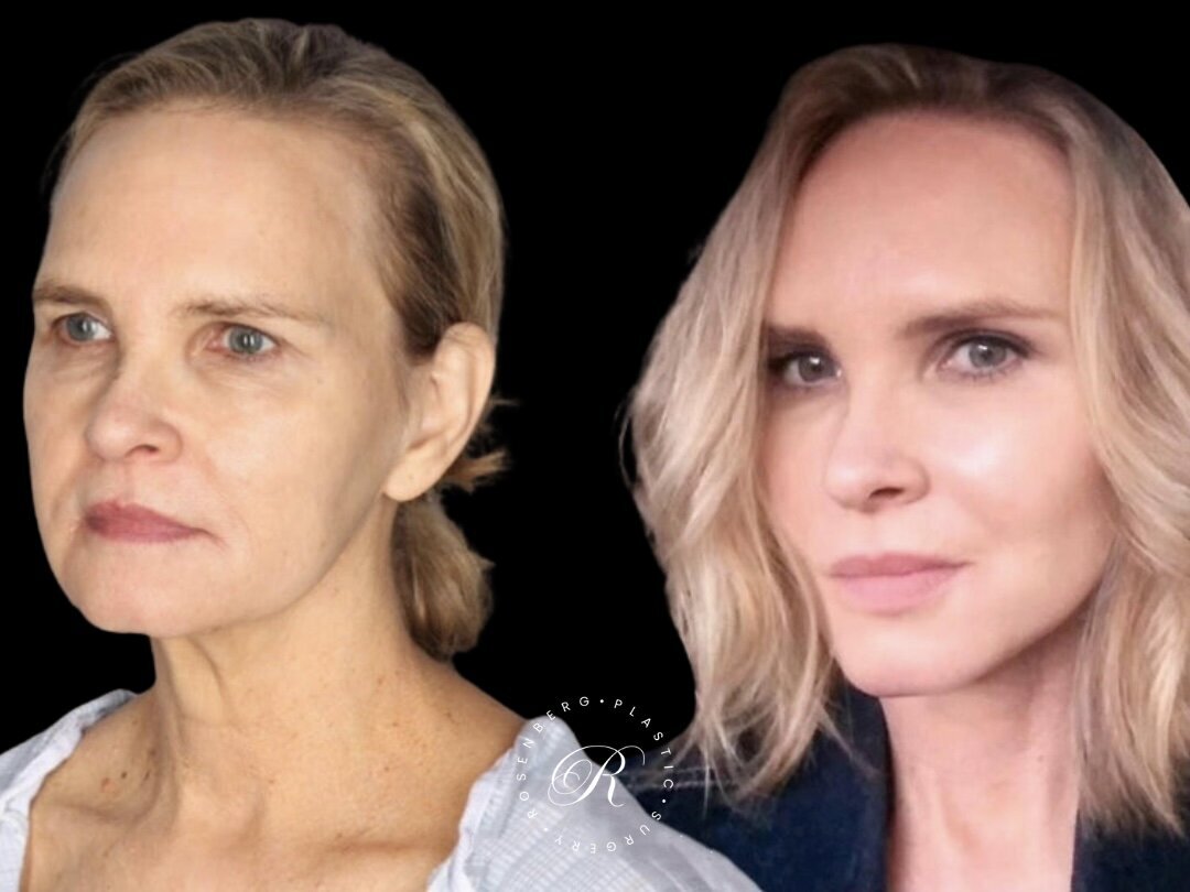 Facelift RPS Before & After.zip - 5