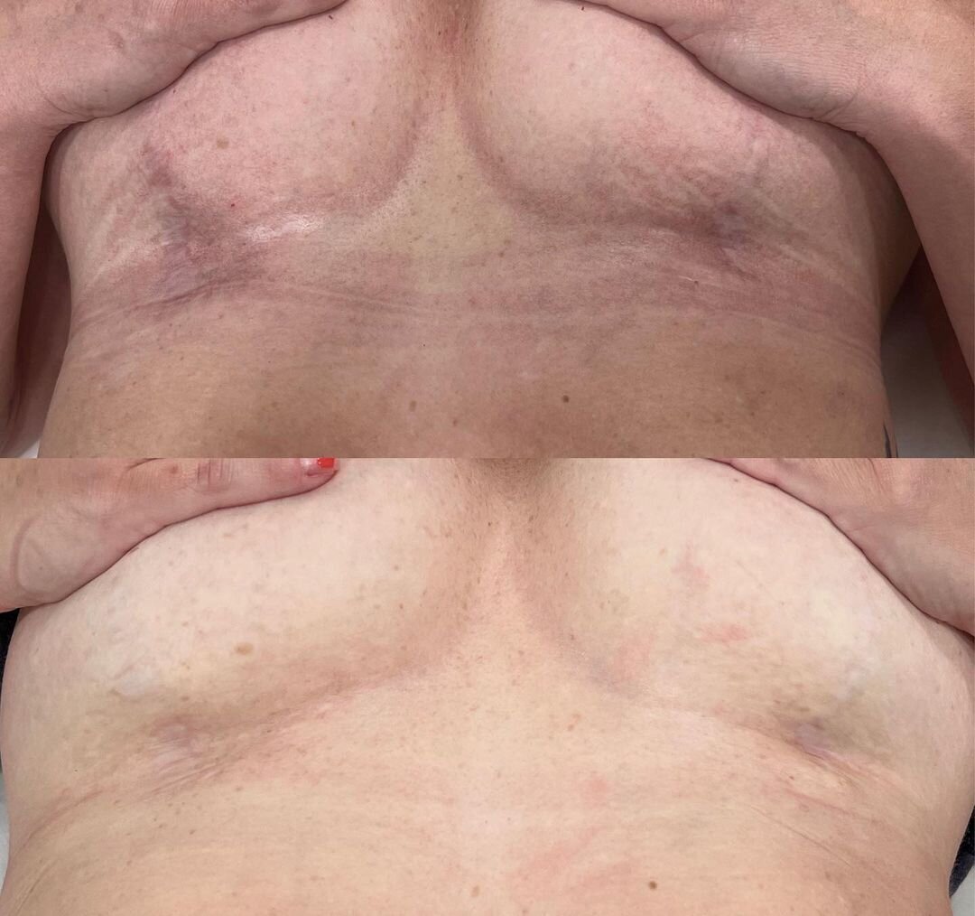 Scar Reduction - Photo Courtesy of Georgia Edlingg & Kristen Shimp, NP