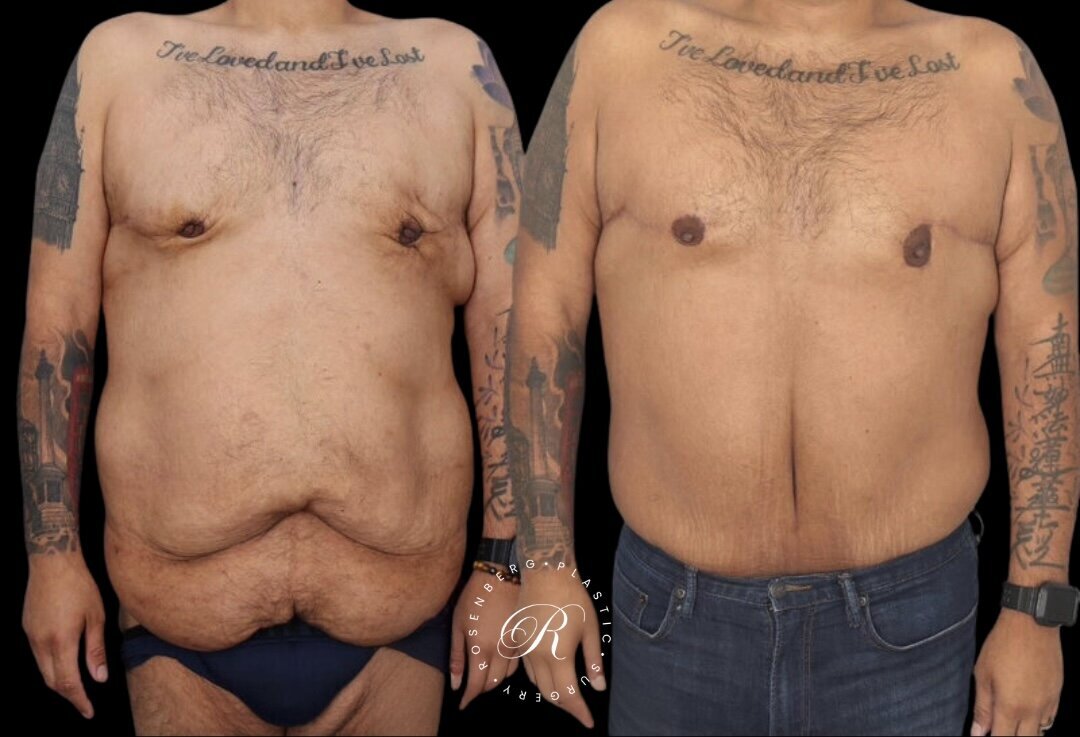 Panniculectomy RPS Before & After.zip - 4
