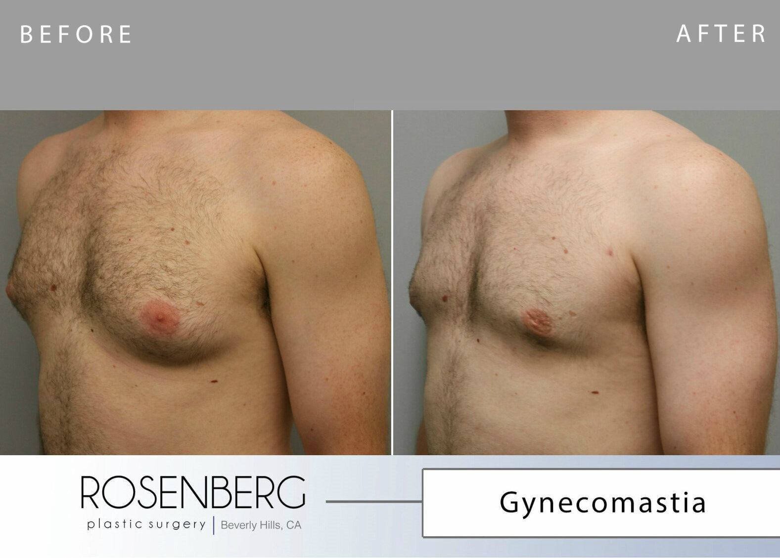 Gynecomastia Results